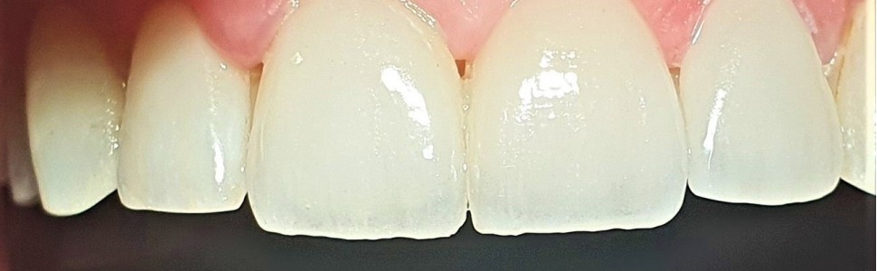 Usuwanie licówek pełnoceramicznych w odcinku przednim (...)