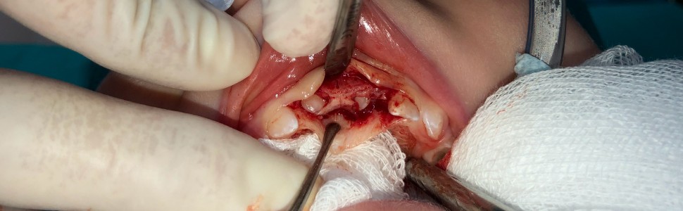 Chirurgiczne leczenie intruzji zębów mlecznych. Opis przypadku