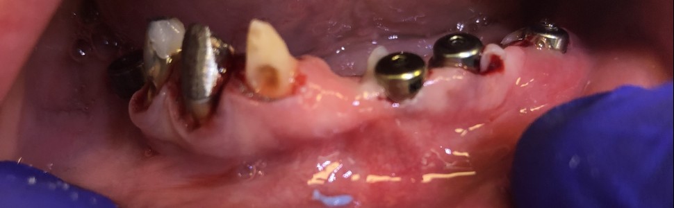 Rehabilitacja protetyczna z zastosowaniem leczenia implantologicznego (...)