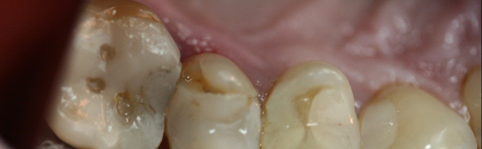 Pionowe złamanie korzenia drugiego zęba przedtrzonowego szczęki (...)