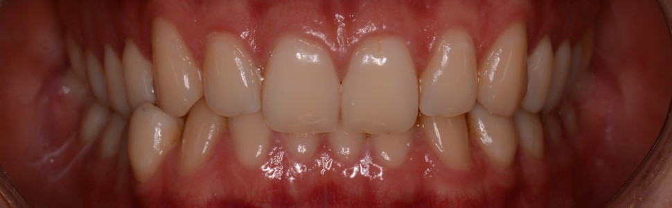 Fotografia stomatologiczna – wpływ lampy błyskowej na zdjęcia