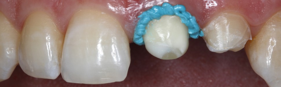 Wykonanie wycisku przedniego zęba szczęki z wykorzystaniem pasty retrakcyjnej