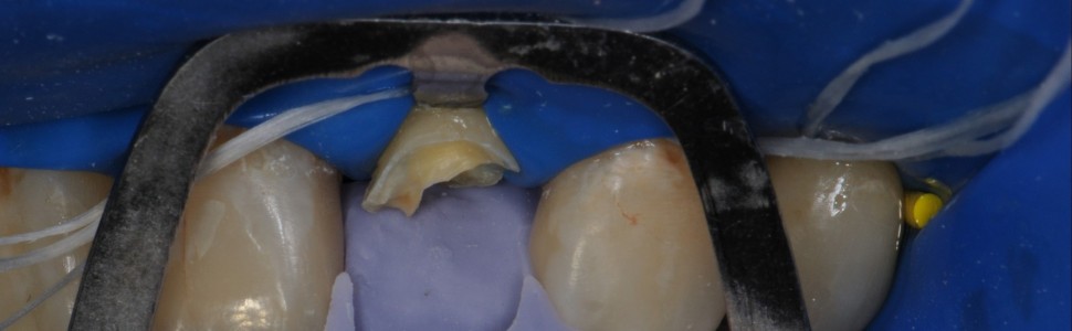 Odbudowa zęba siecznego bocznego szczęki na wkładzie z włókna szklanego