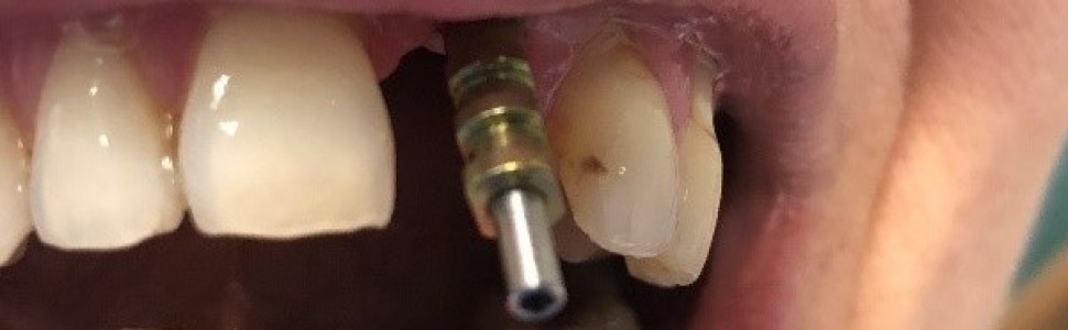 Utrata zęba siecznego przyśrodkowego w szczęce (...)