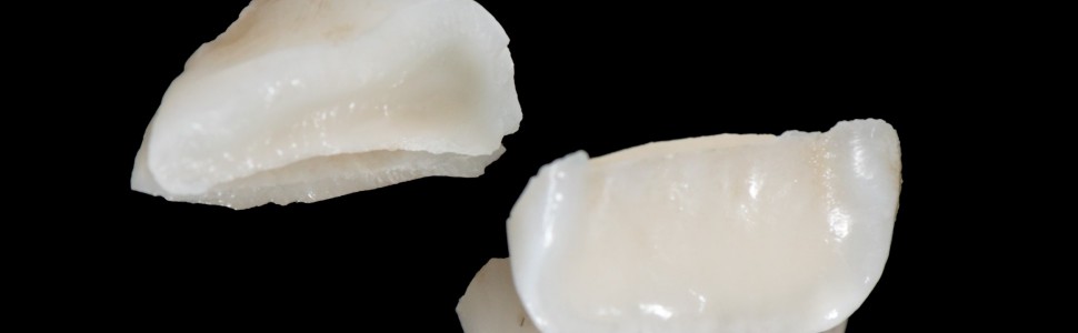 Odbudowa złamanych zębów siecznych przyśrodkowych szczęki (...)