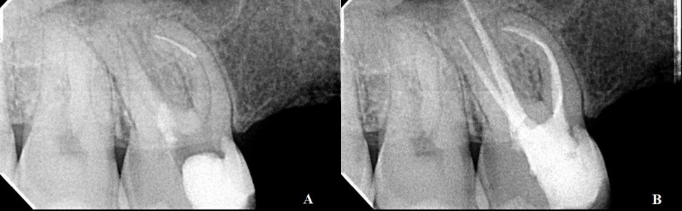 Postępowanie w przypadku złamania instrumentów. Opis przypadków