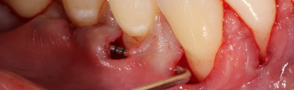 Pokrycie mnogich recesji dziąsłowych całego łuku zębowego na jednej wizycie (...)