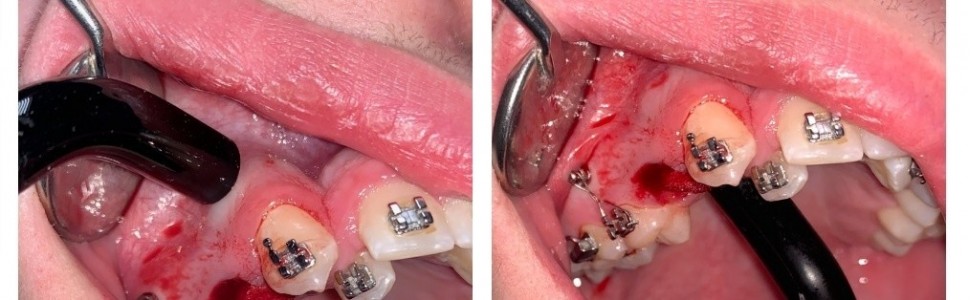Zastosowania biostymulacji laserowej do przyspieszenia leczenia ortodontycznego