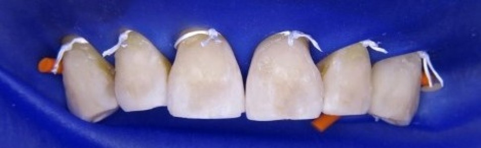 REPORTAŻ KLINICZNY. Odbudowa zęba przedniego materiałem kompozytowym (...)