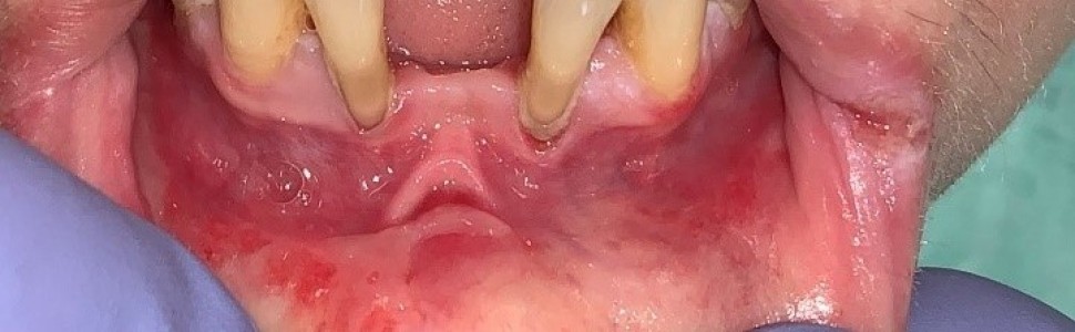 Oral mucositis w przebiegu terapii metotreksatem (...)