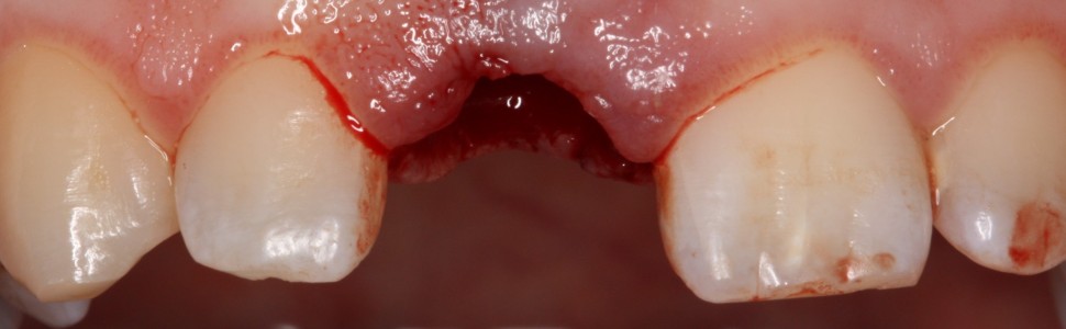 Horyzontalne złamanie korzenia zęba siecznego przyśrodkowego (...)