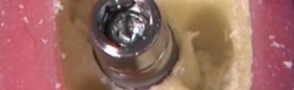 REPORTAŻ KLINICZNY. Metamorfoza kostna – od kondenserów (...)