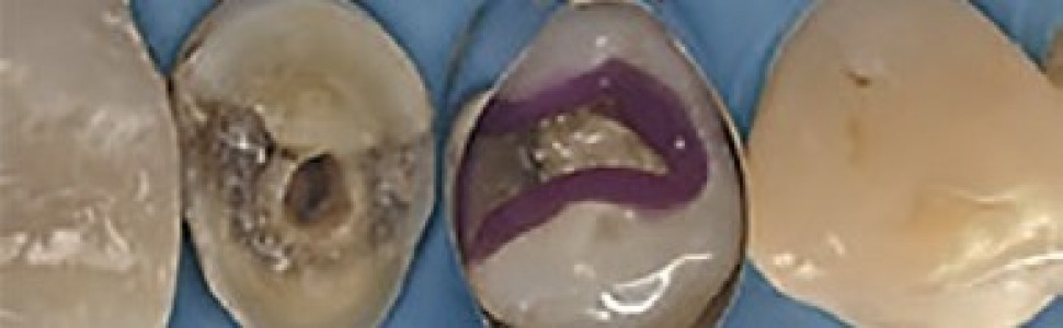 REPORTAŻ KLINICZNY. Bezpośrednie i pośrednie rekonstrukcje zębów (...)