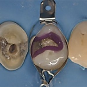 REPORTAŻ KLINICZNY. Bezpośrednie i pośrednie rekonstrukcje zębów (...)