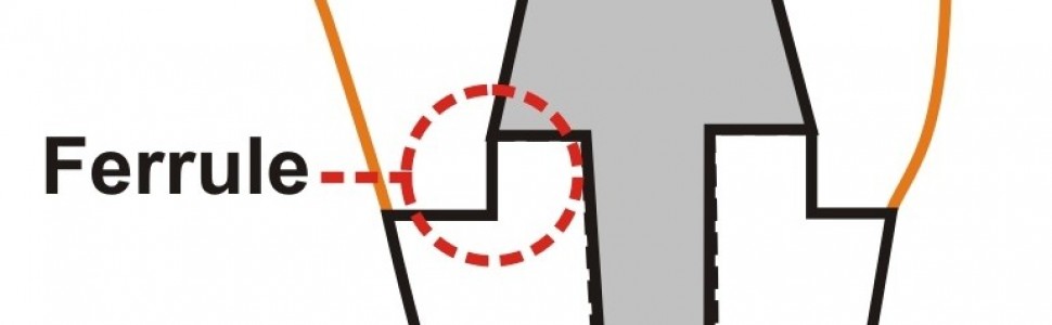 Odbudowa zębów po leczeniu kanałowym (...)