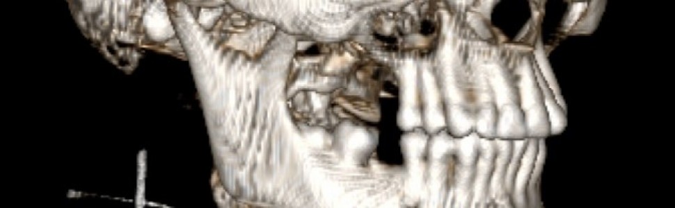 Rak nabłonkowo‑mioepitelialny małych gruczołów ślinowych. Opis przypadku