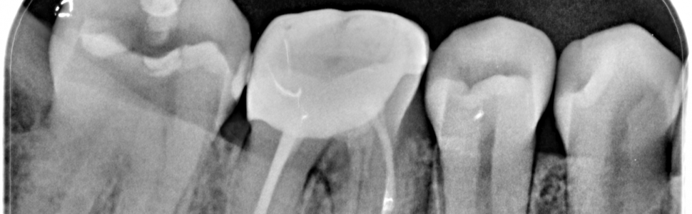 Hemisekcja jako przykład zabiegu z zakresu chirurgii endodontycznej (...)