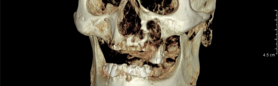 Leczenie rozległej zakażonej torbieli szczęki (...)