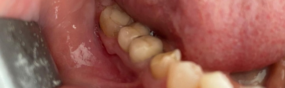 Leczenie periimplantitis przy użyciu lasera erbowo‑yagowego (...)