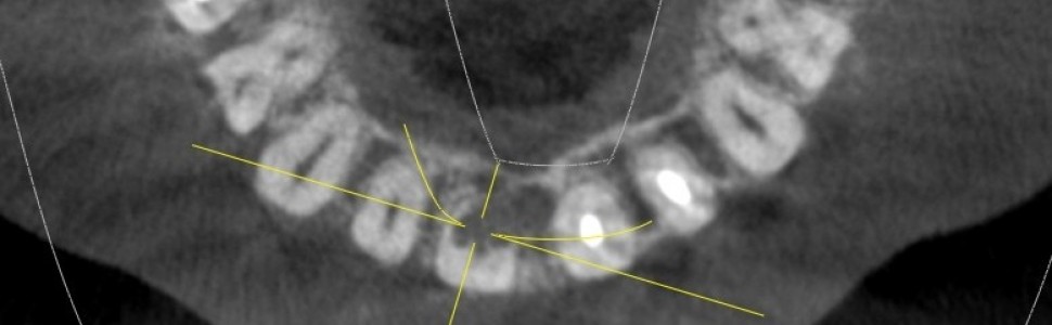 Resorpcja wewnętrzna zęba siecznego przyśrodkowego w dwóch odsłonach (...)