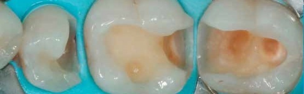 Wypełnienia w odcinku bocznym z użyciem Admira Fusion