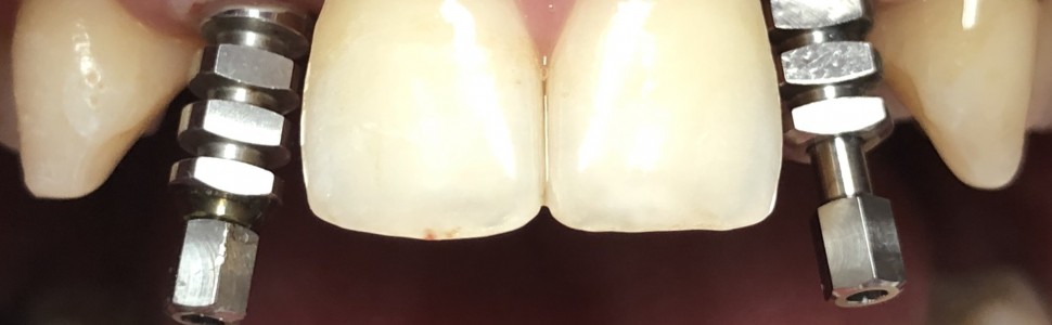 Przebudowa fenotypu dziąsła zębodołowego (...)