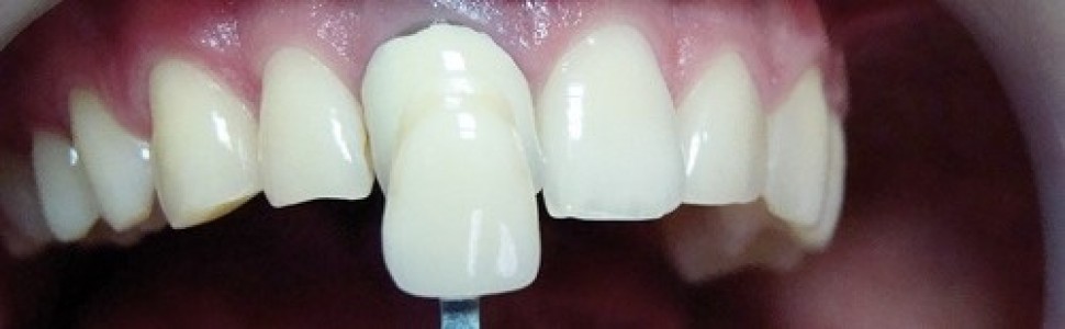 Kompleksowe estetyczne leczenie stomatologiczne 