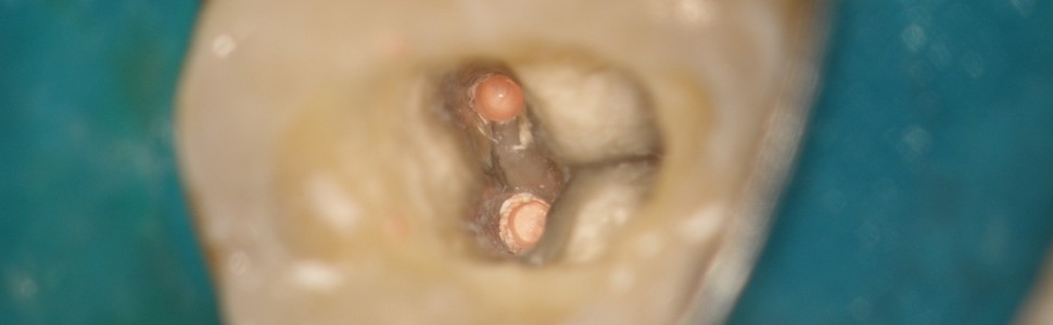 I MIEJSCE W II EDYCJI KONKURSU: Endodoncja ekstremalna czy kompromisowa? Opis przypadku