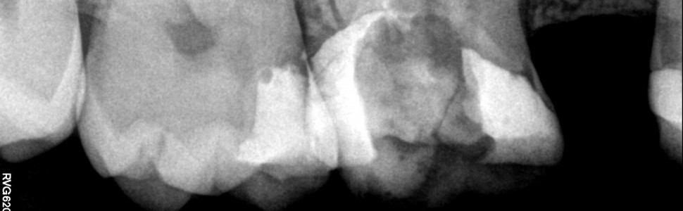 III MIEJSCE W II EDYCJI KONKURSU: Powtórna endodoncja mikroskopowa z mikrochirurgią (...)