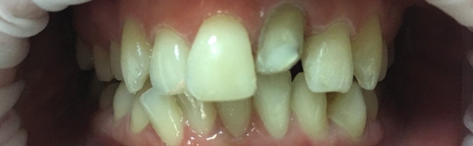 Odroczone zaopatrzenie protetyczne zęba po zwichnięciu (...)