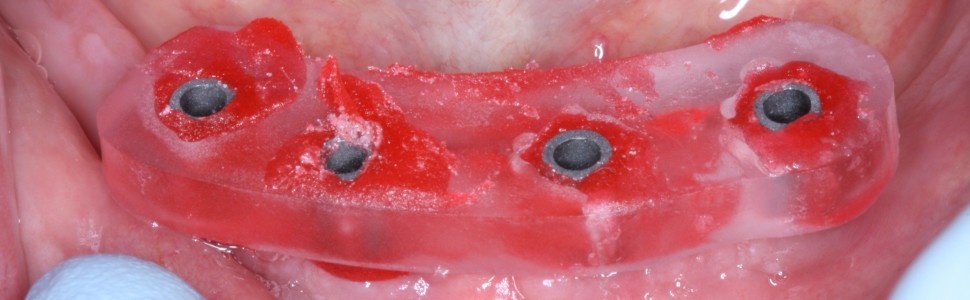 Protetyczne możliwości rekonstrukcyjne u pacjentów bezzębnych