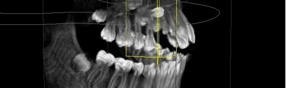 Torbiel zawiązkowa – własne przypadki kliniczne
