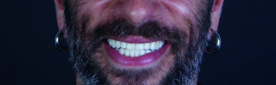 REPORTAŻ KLINICZNY. Estetyczna przebudowa uzębienia u pacjenta z bruksizmem (...)