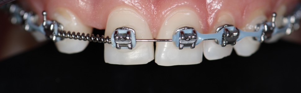 Tymczasowa odbudowa bocznego zęba siecznego szczęki (...)