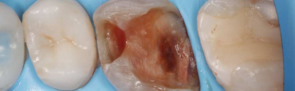 Nakład bezpośredni – kompozytowa odbudowa bezpośrednia z przykryciem guzków (...)