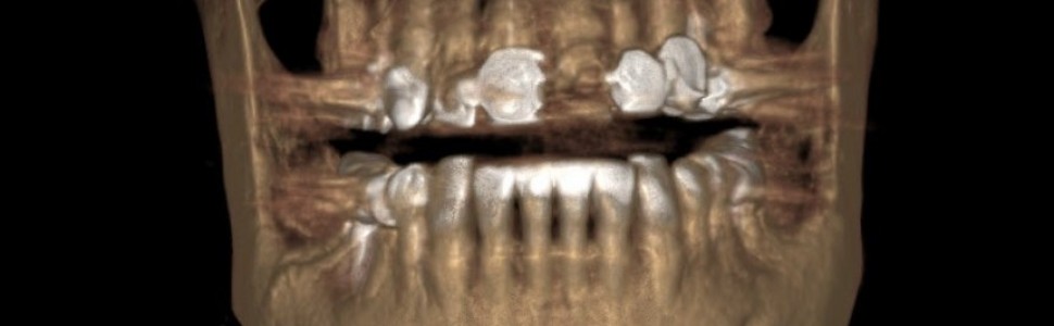 Zastosowanie badania CBCT w leczeniu endodontycznym