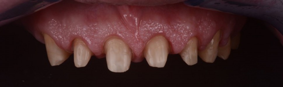 Przebudowa estetyczna z wykorzystaniem wydłużenia koron (...)