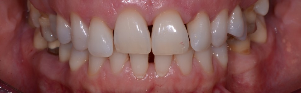 Miejscowa antybiotykoterapia w leczeniu zapaleń przyzębia – opis przypadku