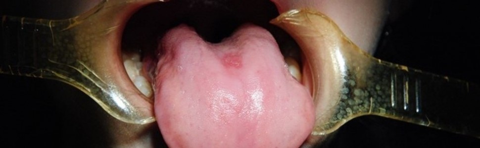 Obraz zmian w jamie ustnej w przebiegu COVID-19 (...)