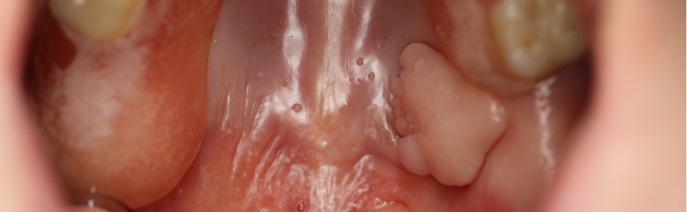 Włókniak urazowy błony śluzowej podniebienia (...)