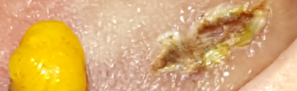 Zastosowanie wielofalowego lasera diodowego do usunięcia tłuszczaka