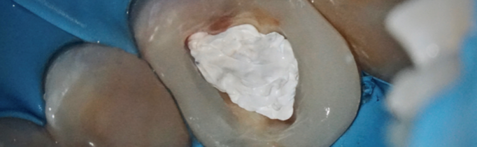 Część 2. Zamykanie i zabezpieczanie dostępu endodontycznego 