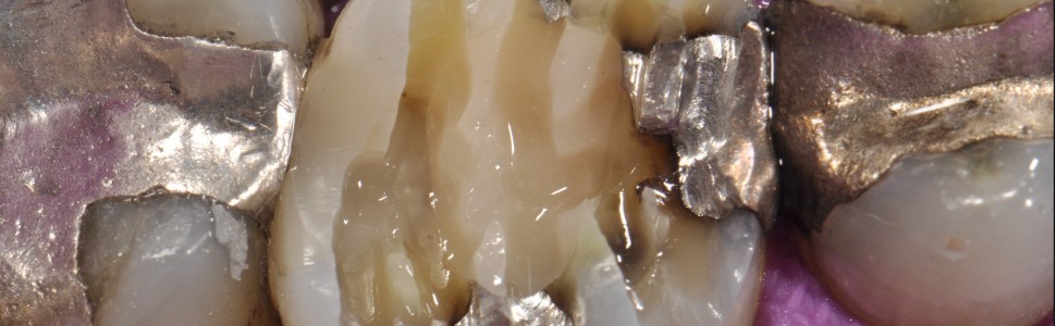 Bezpośrednie, złożone wzmocnienie zębiny okołoszyjkowej zęba leczonego endodontycznie (...)
