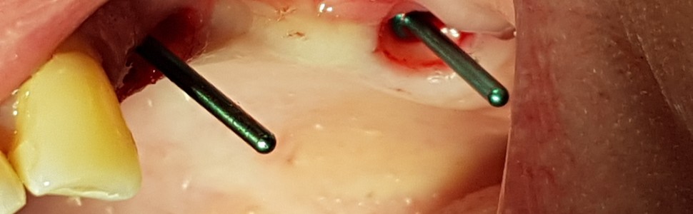 Ultrakrótkie implanty jako skuteczna alternatywa w sytuacji (...)