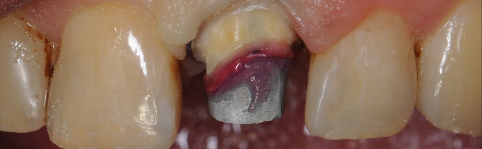 REPORTAŻ KLINICZNY. Korona tymczasowa jako rozwiązanie (...)