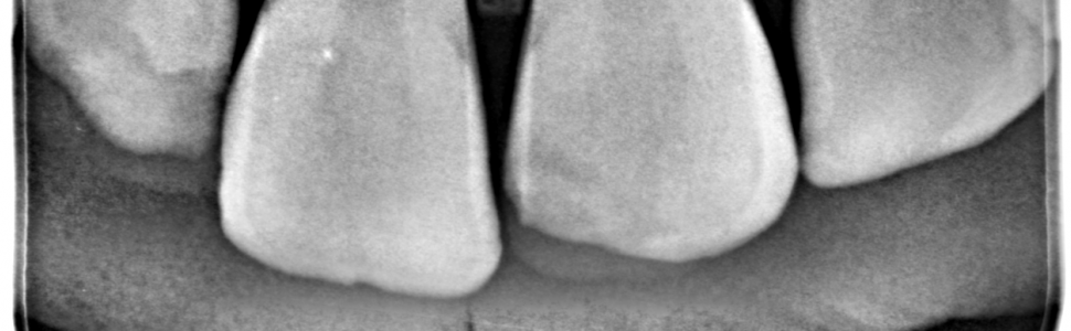 Pourazowa resorpcja zewnętrzna przyszyjkowa – opis przypadku