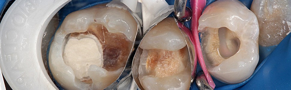 Bezpośrednia odbudowa kilku zębów z użyciem materiału kompozytowego (...)