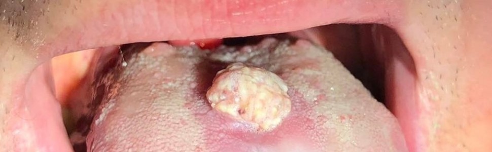 Leczenie brodawczaka płaskonabłonkowego błony śluzowej języka (...)