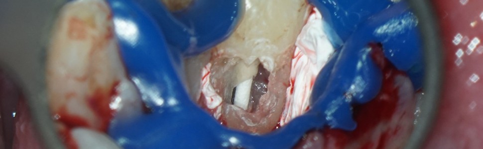 Leczenie zęba siecznego szczęki z resorpcją przyszyjkową i zapaleniem tkanek (...)