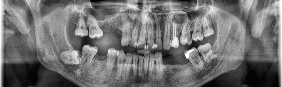 Leczenie zainfekowanej torbieli zęba 24 (...)